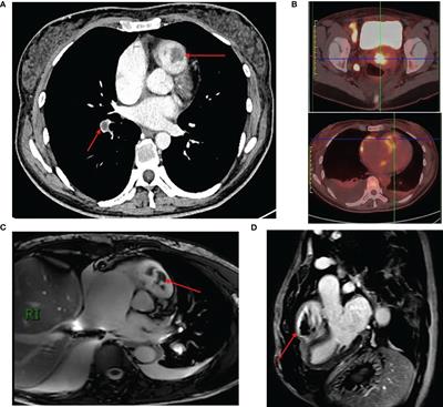 Intracavitary cardiac metastasis of cervical squamous cell carcinoma with immune thrombocytopenia: a rare case report